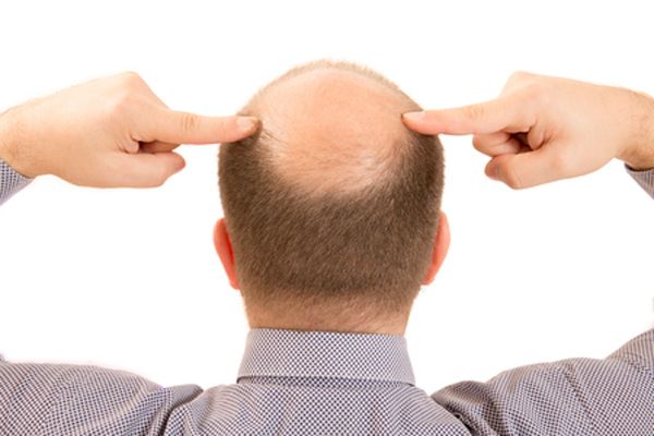 脱发是什么 成年人一天掉多少头发正常 