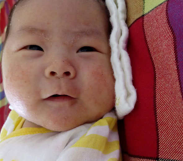 湿疹是怎么引起的_得了湿疹怎么治疗_湿疹吃